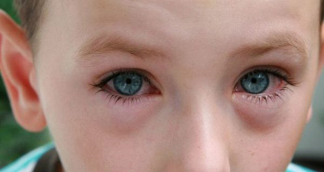 При вирусном или бактериальном заболевании необходимо промывать глаза Фурацилином