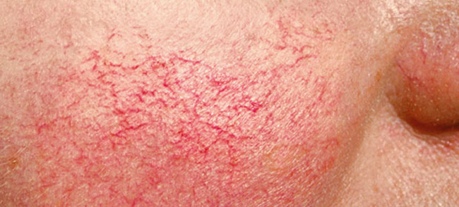 В результате воздействия на кожу внешних факторов, может развиться купероз 