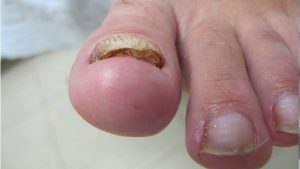В данном виде грибка идет деформация края ногтя, ногтевая пластина теряет цвет и значительно утолщается