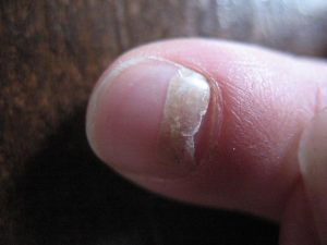 При появлении данного вида грибка ногтевая пластина, со временем, может и вовсе отслоиться