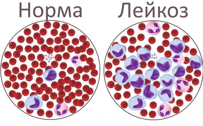 Как выглядит заболевание клеток крови - лейкоз