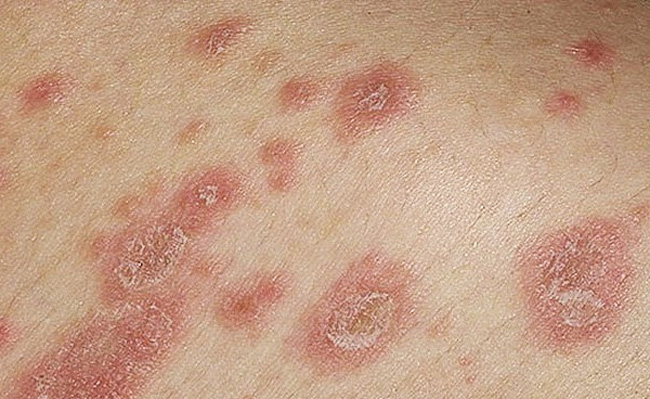Отрубевидный лишай - присутствует в неактивной форме на коже у каждого человека, в возрасте 35-40 лет, при ослаблении иммунитета, может перейти в активное состояние