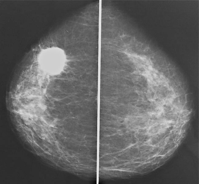Маммография иногда дает ложноположительные результаты при диагностике в том случае, если у женщины есть естественные уплотнения в груди (которые могут быть нормой)