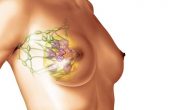Как проявляется мастопатия молочных желез? Симптомы и лечение патологии