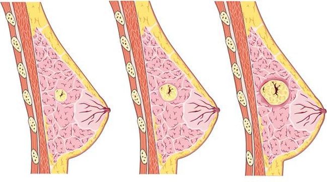 Зачастую признаки мастопатии молочной железы на начальной стадии болезни незаметны