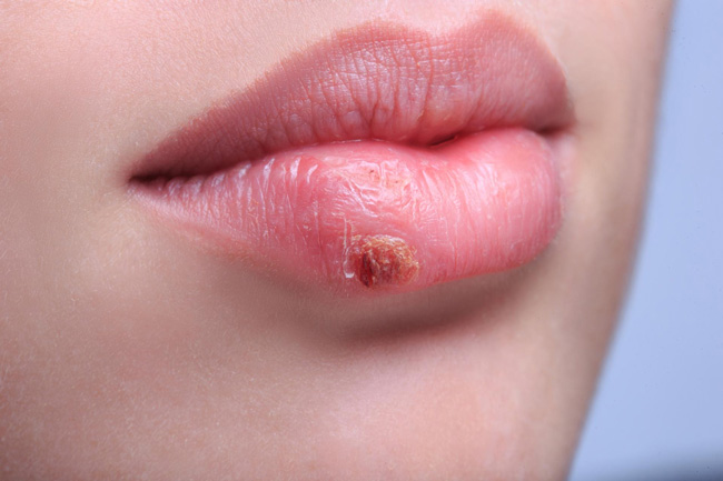 Мазь от простуды на губах — незаменимое средство при появлении первых симптомов герпеса