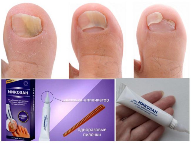 Терапевтический эффект отсутствует при нанесении средства на ногти, покрытые лаком для ногтей и др. Перед использованием Микозана следует очистить ногти