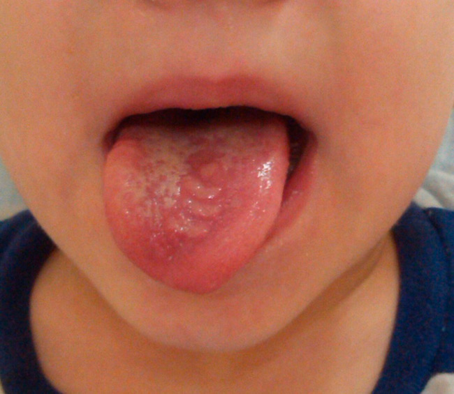 Инфекционный мононуклеоз у детей может носить острый или хронический характер