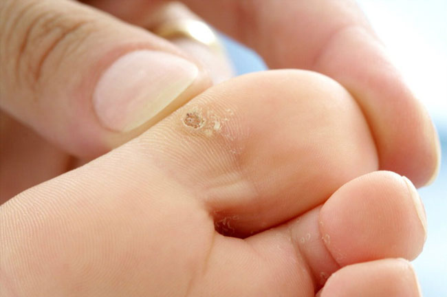 Сухие мозоли могут быть очень болезненными, так как локализуются даже между пальцами ног и разрастающийся участок ороговевшей кожи начинает сдавливать нервные окончания