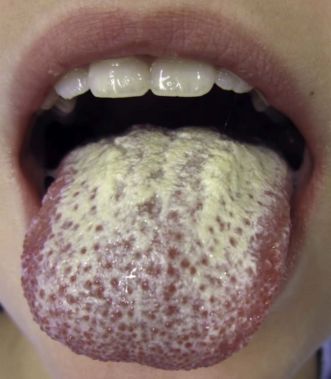 Налет на корне языка появляется из-за активной деятельности микроорганизмов