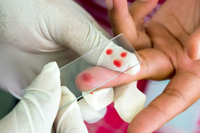 Для анализа уровня тромбоцитов чаще всего берут кровь из пальца
