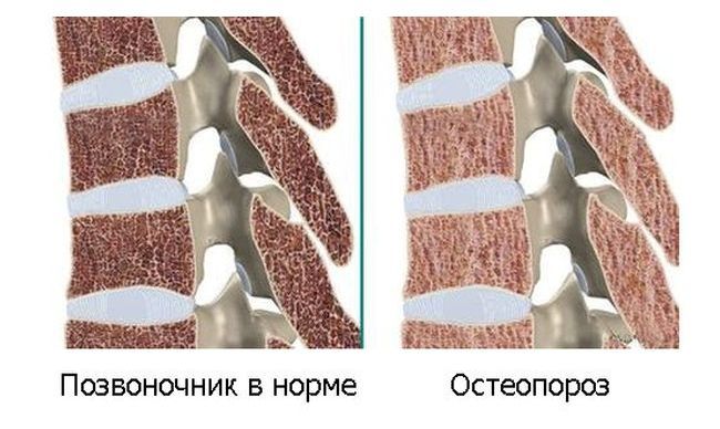 При остеопорозе кости стелета становятся пористыми и более ломкими