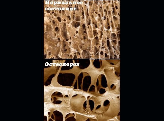 Плотности костной ткани в нормальном состоянии и при остеопорозе