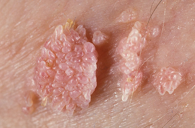 Папиллома – это общее название доброкачественных опухолевидных образований кожи и слизистых оболочек бородавчатого характера