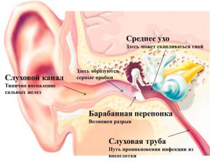 Врачи назначают капли Отипакс при отите разного происхождения, независимо от тяжести заболевания, поскольку он эффективен и устраняет боль в ухе Врачи назначают капли Отипакс при отите разного происхождения, независимо от тяжести заболевания, поскольку он эффективен и устраняет боль в ухе