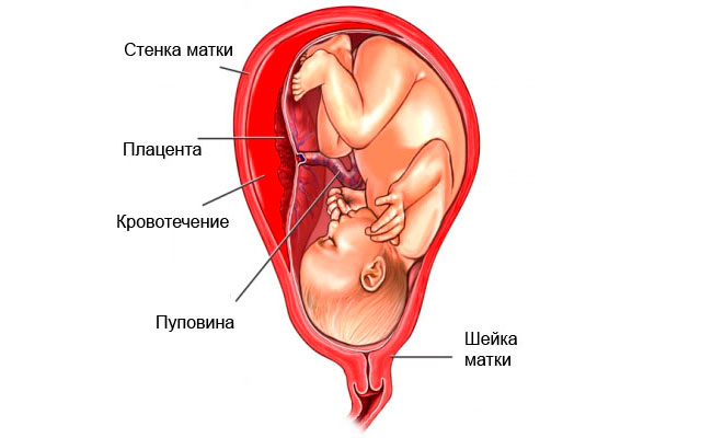 Отслойка плаценты – это ее отделение, частичное или полное, от слизистой оболочки матки, данный процесс опасен для малыша, так как может лишить его кислорода и полезных веществ