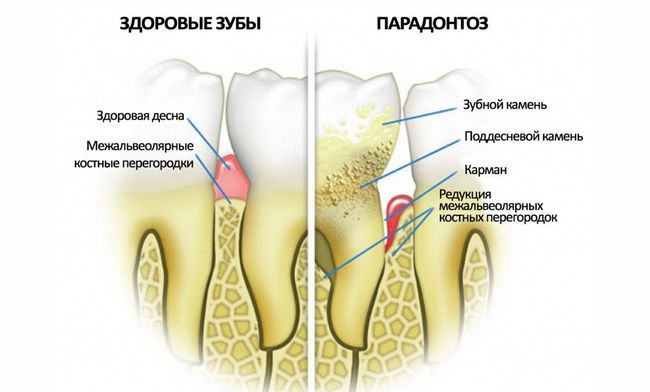 Как выглядит пародонтоз. На фото показаны здоровые зубы и пораженные пародонтозом