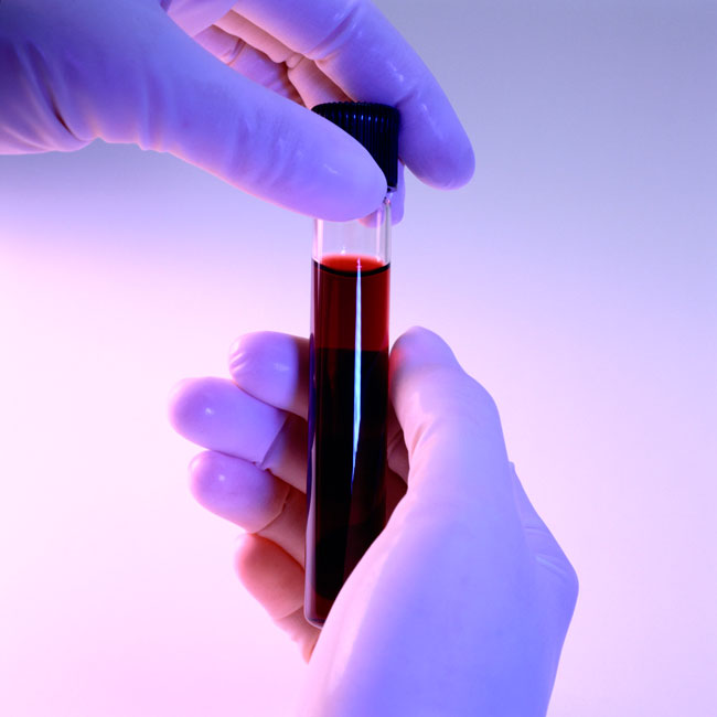 Общий анализ крови поможет выявить генерализованное воспаление, типичными признаками которого обычно выступают: высокая концентрация лейкоцитов, высокая скорость оседания эритроцитов