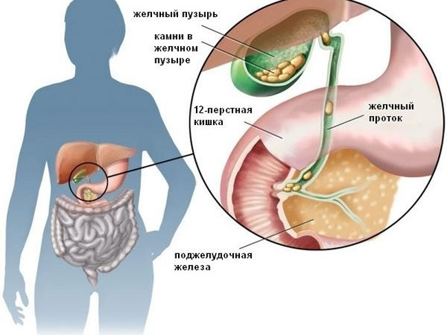 Желчнокаменная болезнь или воспаление желчного пузыря, могут быть причиной возникновения хронической формы панкреатита