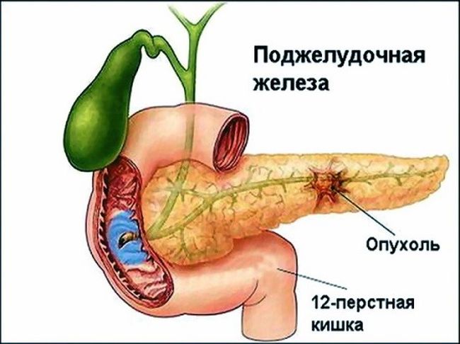 Опухоли поджелудочной железы бывают гормональные и онкологические