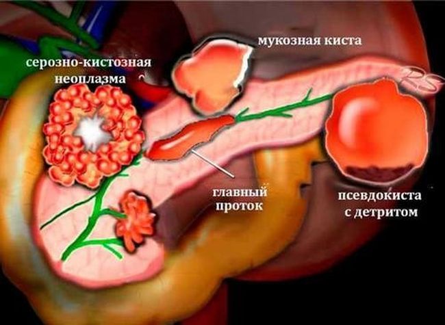 Киста поджелудочной железы - это капсула внутри органа, в которой накапливается жидкость. Удаляется только хирургическим путем