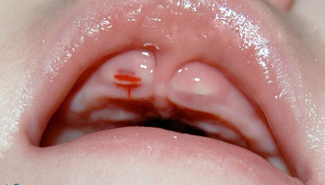 При гемофилии, прорезывание зубов сопровождатеся сильным выделением крови