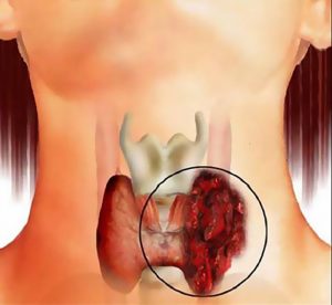Щитовидная железа отвечает за рост практически всего в организме, поэтому любое негативное воздействие, будто радиоактивное или банальный дефицит йода, приводит к плачевным последствиям.