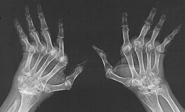 Пораженные ревматоидным артритом кистей рук