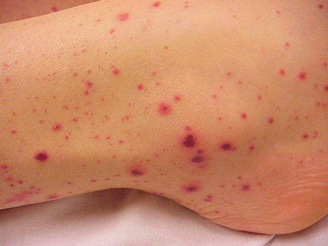 При септицемии на коже появляются мелкие красные точки, которые с осложнением болезни перерастают в кровоизлияния по всему телу