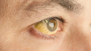 Желтые склеры глаз или желтая кожа - это самые явные признаки синдрома Жильбера.