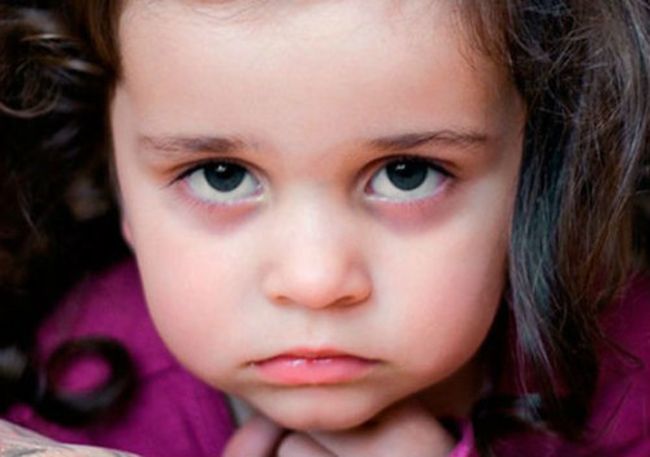 Глистная инвазия - еще одна из причин, по которой у ребенка под глазами могут наблюдаться синяки