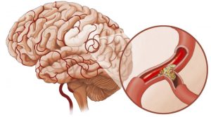 Спазм сосудов головного мозга - это крайне опасная патология, которая может привести к инсульту, если во время не начать её лечение