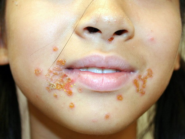 Наиболее частая локализация стрептордермии у ребенка, щеки, губы и в носу
