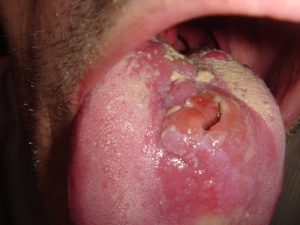 На первичной стадии заболевания сифилисом появляется твердый шанкр на слизистой оболочке рота или половых органов у мужчин и женщин