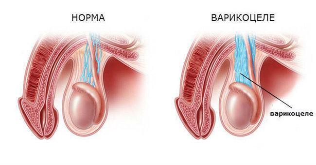 Вариркоцеле у мужчин – заболевание снижающее качество и количество продуцируемых сперматозоидов