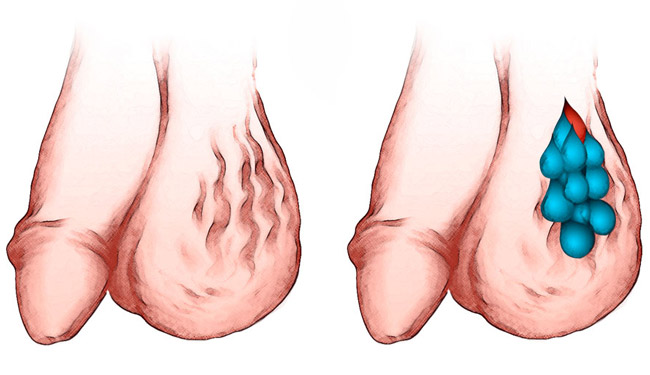 Нарушение венозного оттока у семенного канатика и яичка, постепенно приводит к полной или частичной половой дисфункции