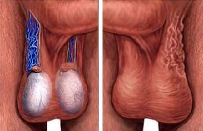 Симптомы варикоцеле у мужчин проявляются по мере расширения венозной сетки семенного канатика