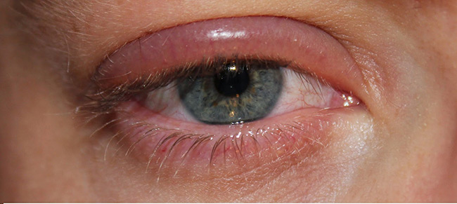 Первые признаки аллергии достаточно легко распознать, основной симптом аллергии — красные глаза, опухшие веки, слезоточивость и зуд, часто появляется насморк