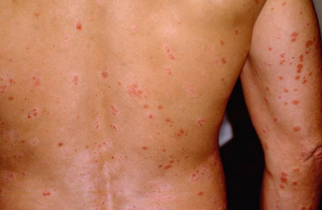 При первых проявлениях инфекции возможно появление сыпи на коже – как по всему телу, так и локально, например, области гениталий