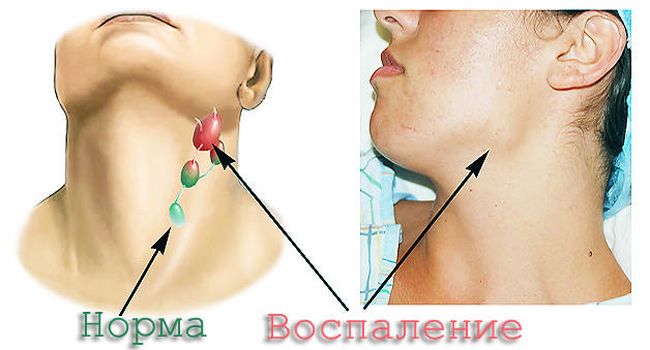 Воспаление лифоузлов на шее и их нормальное состояние
