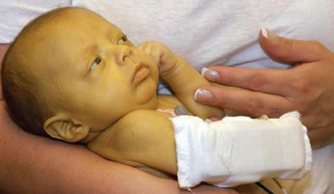 С помощью Урсосана лечат желтуху у новорожденных детей