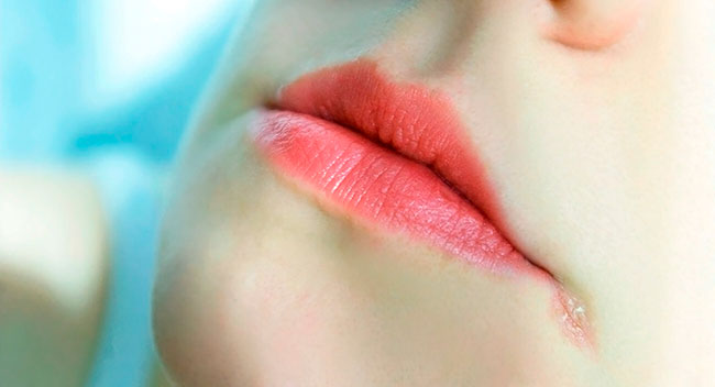 При появлении заеды возникает дефект кожи в уголке рта, который сопровождается воспалением тканей в зоне поражения и окружающих участков