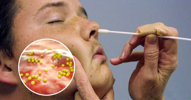 При золотистом стафилококке в носу, активно размножающиеся бактерии в носоглотке человека вызывает гнойно-воспалительные процессы