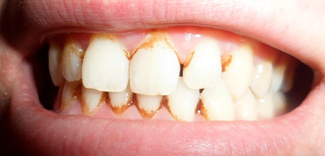 Зубной камень – это известковые отложения на эмали, которые могут появиться даже у тех, кто регулярно ухаживает за ротовой полостью