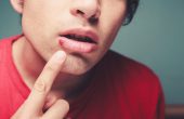 Герпес (простуда) на губе – симптомы, как быстро вылечить